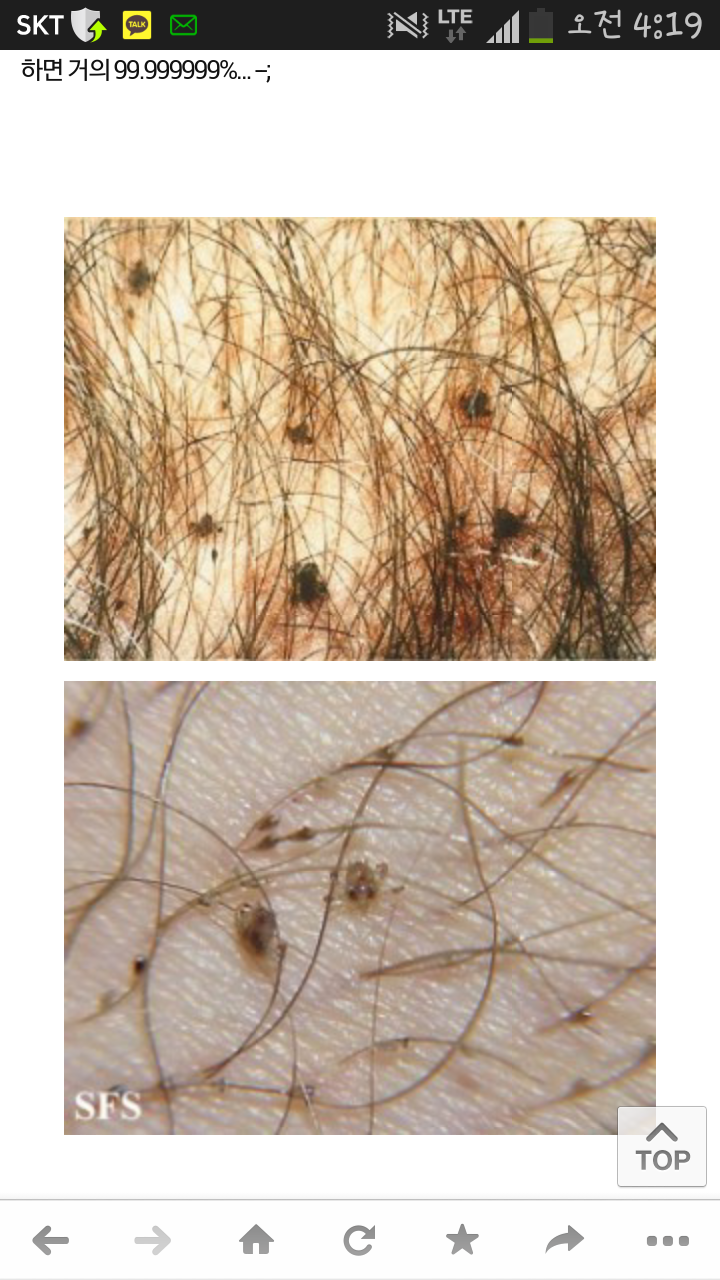 사면발이저장소)성관계나 숙박업소에서 기생충조심해라 | 일간-베스트 | 일베저장소